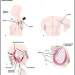 Open Bankart Surgery