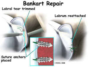 Open Bankart Surgery - Source: eorthopod.com