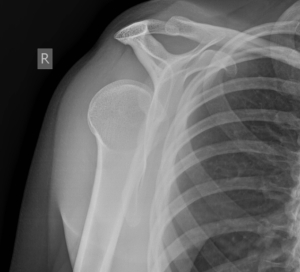 This is what I saw in the ER basically... yeah. Posterior Shoulder Dislocation - Courtsey of http://lifeinthefastlane.com